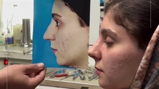 نتیجه بعد عمل بینی که شکستگی و انحراف داشت