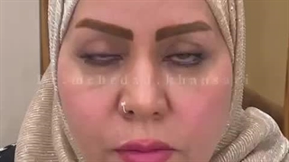 عمل پف بالای چشم یا بلفاروپلاستی پلک بالا