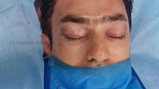 لیفت اندوسکوپی ابرو