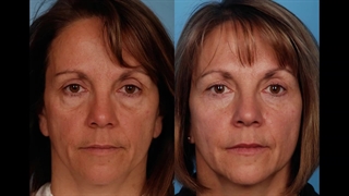 جراحی زیبایی پلک