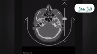 شوانوم فاسیال