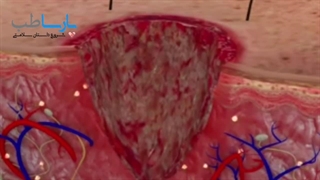 تشخیص زخم عفونی