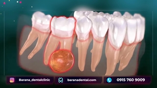 چگونه کیست ریشه دندان باعث دندان درد می شود؟