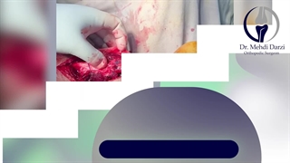 پارگی کامل آشیل به هنگام ورزش