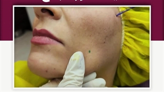 لیفت صورت با نخ دندان پیش