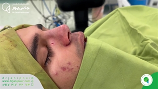 جراحی بینی دارای انحراف شدید و قوز، به صورت طبیعی و نچرال