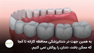 آشنایی با روکش های دندان (ساده و مختصر)
