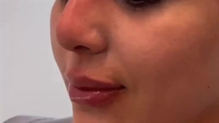 تزریق ژل لب و فیلر بینی توسط پزشکان مجموعه مزوتراپی