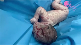 2زایمان سزارین