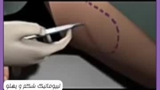 هزینه لیپوماتیک شکم و پهلو در کرج