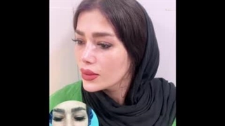 دکتر عارف زاده ، جراح زیبایی بینی و متخصص گوش و حلق و بینی. پنج ماه بعد از عمل.