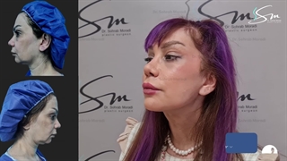 لیفت صورت، سانترال لب و لیفت اندوسکوپی ابرو