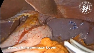 Steps in Laparoscopic Heller's cardiomyotomy: pars Flaccida approach آشالازی و