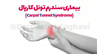 عوارض عمل عصب دست