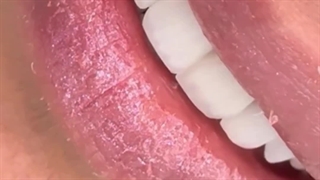 لمینت سرامیکی با فرم و رنگ طبیعی در کلینیک بارانا مشهد