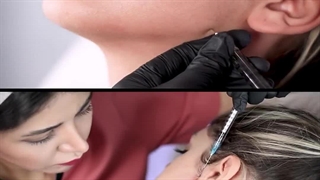 کانتورینگ صورت با تزریق ژل