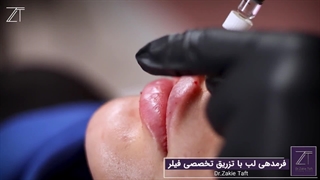 لب مدل طبیعی + بهترین روش تزریق✅