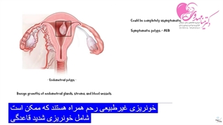 اندومتریوز