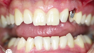 یک واحد ایمپلنت : دکتر وحید دهقان