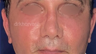 یکماه پس از لیفت کامل صورت | دکتر خوروش