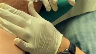 تزریق بوتاکس زیر بغل (بوتاکس تعریق)