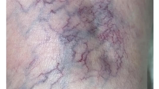 درمان واریس از طریق اسکلروتراپی