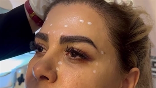 تزریق بوتاکس کاشت مو