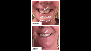 درمان لبخند لثه ای