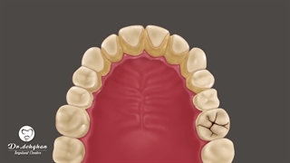 جرمگیری دندان