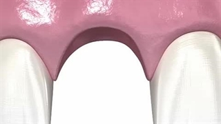 مراحل ایمپلنت دندان، آیا ایمپلنت درد دارد؟