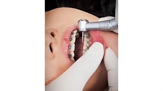 اصلاح طرح لبخند