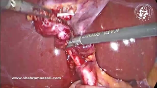 باقی‌مانده مجرای سیستیک به عنوان یک علت نادر برای سندرم بعد از برداشتن کیسه صفرا