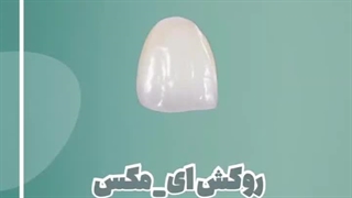 معرفی انواع روکش دندان