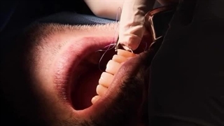 کشیدن دندان و کاشتن ایمپلنت در همان روز برای 6 دندان