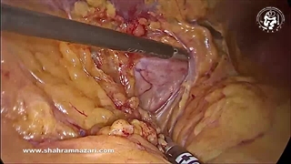 چین خوردگی؛ یک عارضه نادر گاسترکتومی آستینی (اسلیو)