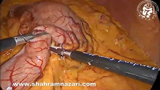 برداشتن عمل جراحی تومور استرومایی معده-روده (GIST) به روش لاپاراسکوپی