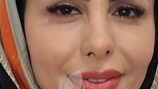 تزریق بوتاکس در کلینیک آوینا