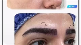 کاشت ابرو در کلینیک آوینا